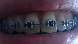 My teeth with braces
