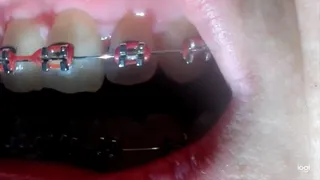 My teeth with brazes in big close up No audio No sound