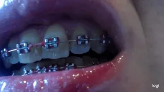 Teeth with brazes on me No audio No sound