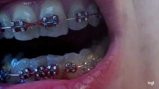My teeth with brazes on