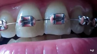 My teeth with brazes to cam