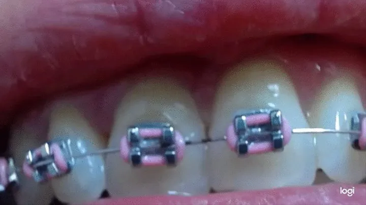 6 minutes my teeth with braces