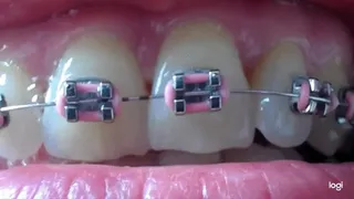 11 minutes of my teeth with braces to cam