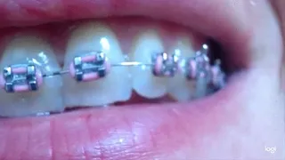 Few minutes of my braces on my teeth