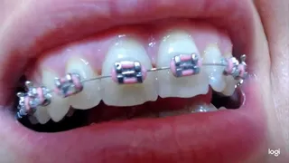 My teeth with braces on them