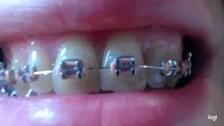 4 minutes teeth with brazes to cam