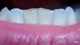 6 minutes down teeth to cam