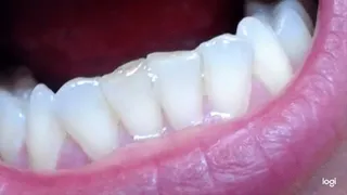 5 minutes teeth to cam