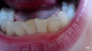 8 minutes my teeth to cam