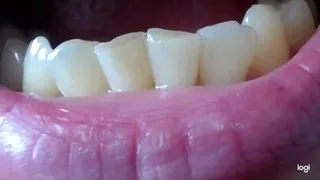 15 minutes teeth to cam