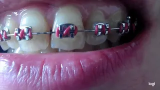 Teeth with brazes on No audio No sound