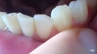 5 minutes my down teeth to cam