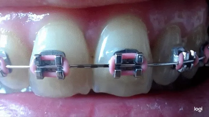 2 minutes my teeth in brazes to cam