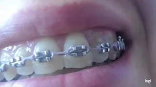 Teeth with brazers to cam