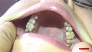 Upper teeth [LINDA]