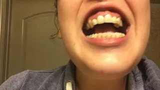 Pale Babe Showing Off Bad Teeth and Cavities