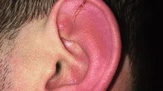 Poor ears