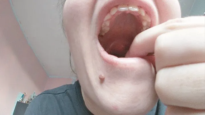 Big tonsil stones mine