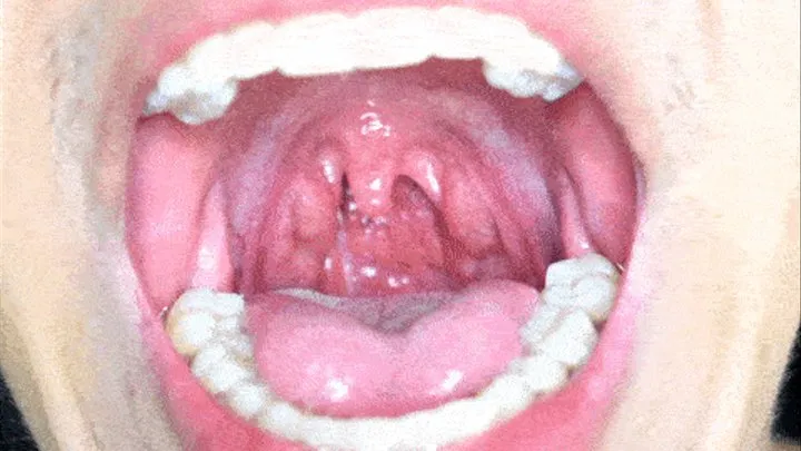 large uvula