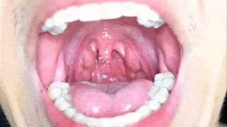large uvula
