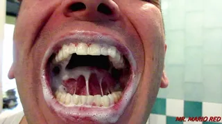 Teeth Cleaning