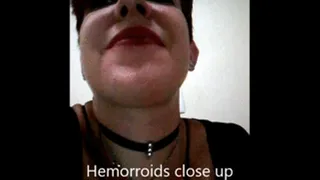 Hemorrhoids Close up