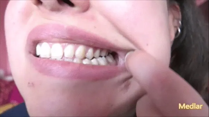 Perfect teeth [HOPE],