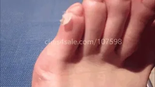 A dry flap of skin on my foot