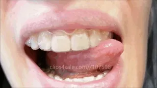 New Invisalign trays and mouth tour