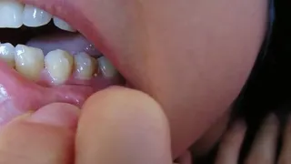 Invisalign attachments