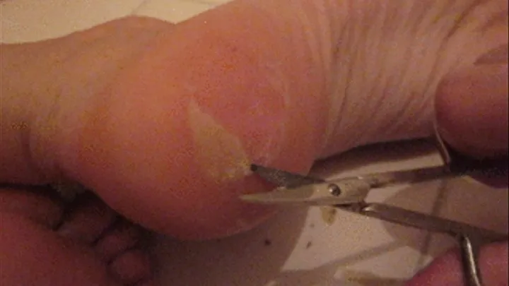 Cutting a dirty flap of skin from my foot PART 2