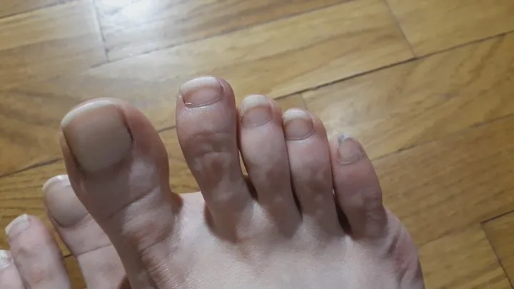 dirty messy toenails