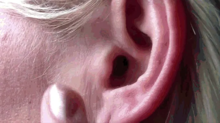 The procedure for cleaning contaminated ears