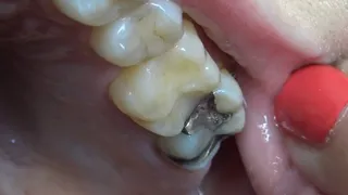 Exploring old Silver fillings