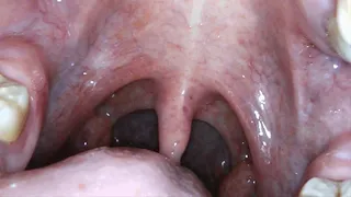 Deep Inside My Mouth, Endoscope Mouth Shots