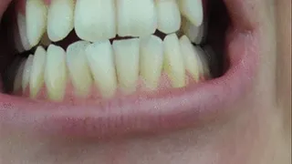 Teeth Chattering and Grinding