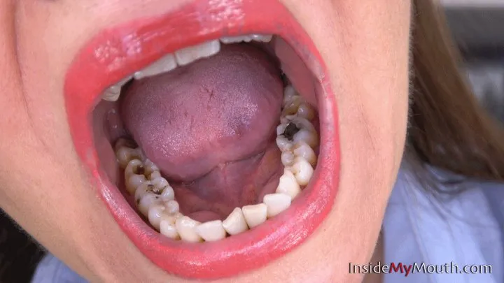 Inside My Mouth - Suzanne - mouth tour, amalgam fillings!