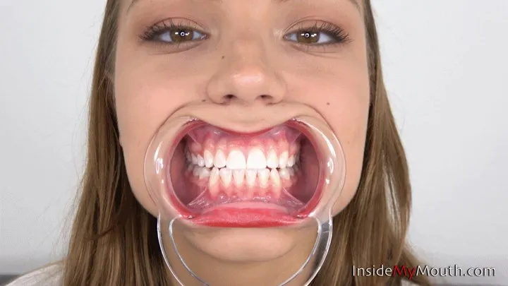 Inside My Mouth - Maria - Mouth retractor insertion! ( )