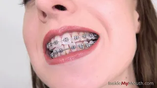 Inside My Mouth - Jennifer - Dental braces clip! ( )