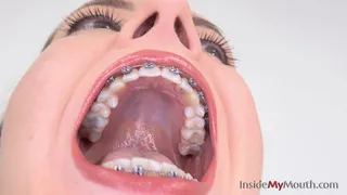 Inside My Mouth - Jennifer - Dental braces clip!