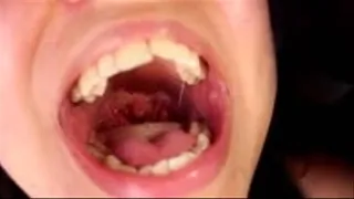Tonsillectomy?