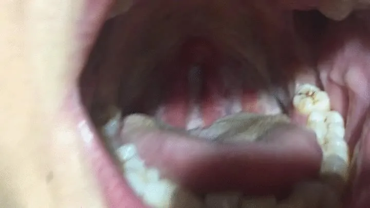 Uvula, sore throat and gag reflex