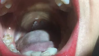 Uvula,uvula,uvula and more uvula