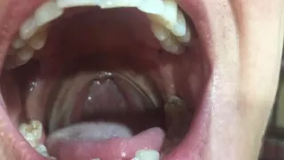 Yawning and showing my dancing uvula