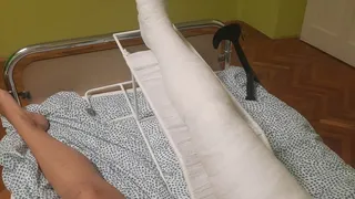 Betti long leg walking cast making in the hospital