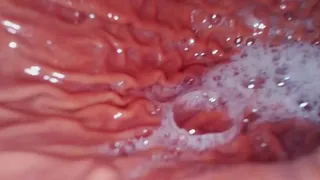 Carolyn: Throat to Gut (ENDOSCOPIC FOOTAGE)