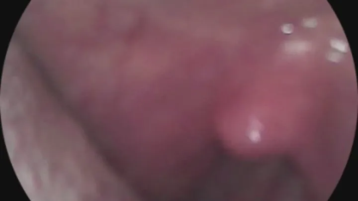 endoscope view- close up to juicey wet tongue, with views of the throat and uvula